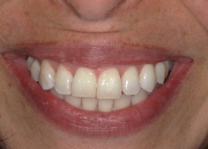 Post-clear aligners: symmetrical smile, even incisor edges, minimal midline diastema, healthy pink gingiva
