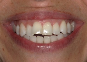 Pre-clear aligners: upper central incisors spaced with slight rotation, uneven incisal edges, mild gingival redness