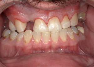 upper anterior teeth restored with uniform white, smooth veneers