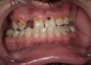 discolored, chipped, and uneven upper teeth with brown staining and mild gingival recession