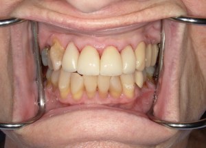 Intraoral view post-treatment: improved tooth alignment, reduced crowding, and healthier gingiva