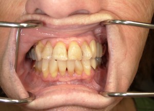 Intraoral view pre-treatment: severe crowding, yellowing, and gingival inflammation